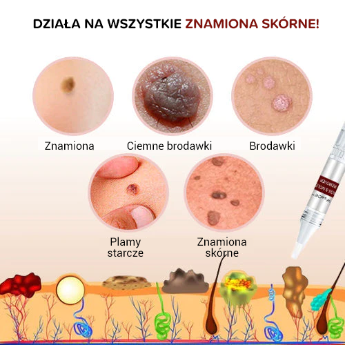 Premiun - Krem w długopisie do usuwania mrówek, kretów i brodawek skórnych 🦠